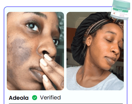BONDABOU SHOP TACHES BRUNES, HYPERPIGMENTATION DU MÉLASMA ?