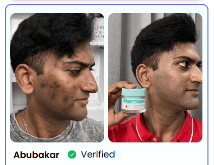 BONDABOU SHOP TACHES BRUNES, HYPERPIGMENTATION DU MÉLASMA ?