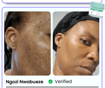 BONDABOU SHOP TACHES BRUNES, HYPERPIGMENTATION DU MÉLASMA ?