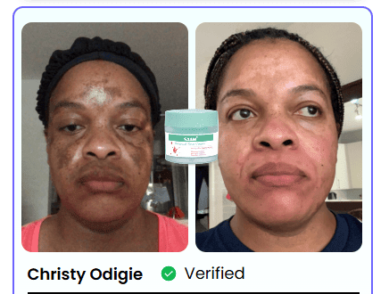 BONDABOU SHOP TACHES BRUNES, HYPERPIGMENTATION DU MÉLASMA ?