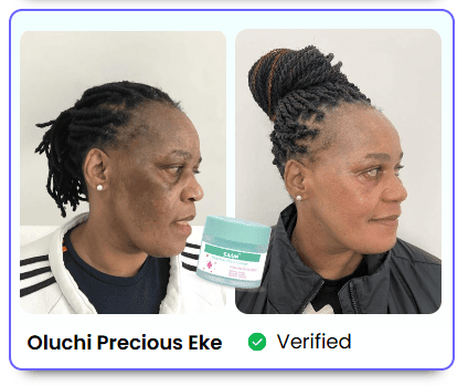 BONDABOU SHOP TACHES BRUNES, HYPERPIGMENTATION DU MÉLASMA ?